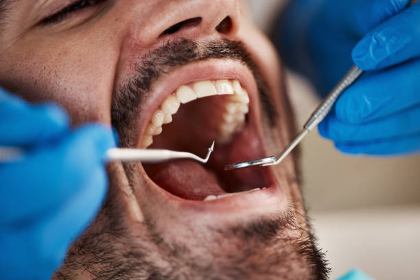 Best Emergency Root Canal Treatment in Evans City, PA